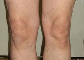 Az Osteflex kezelés után az ízületek visszaállnak a normális állapotba